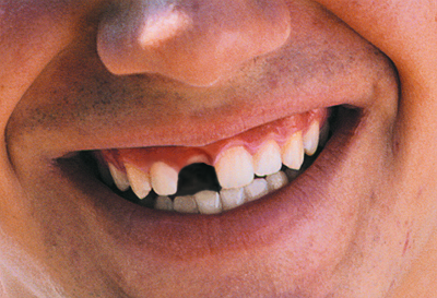 Zahnlücke in der Front